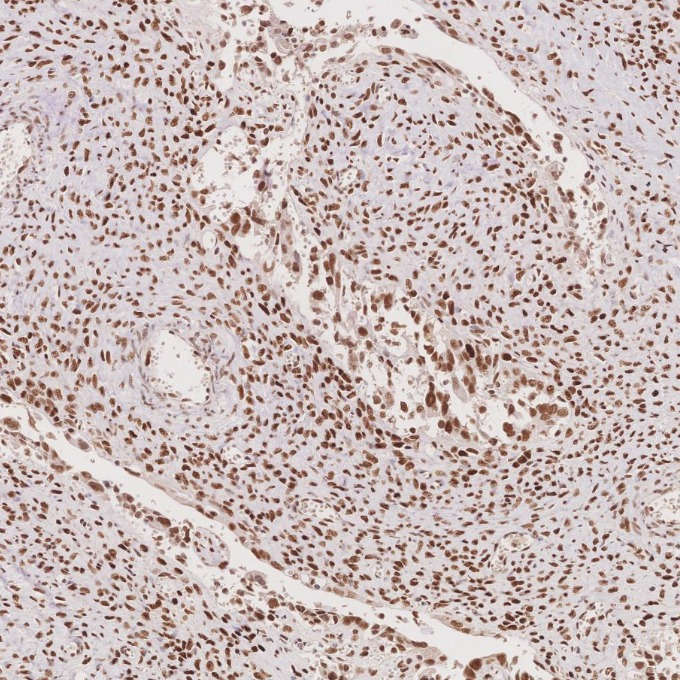 IHC staining of human ovary cancer using 66172-2-Ig