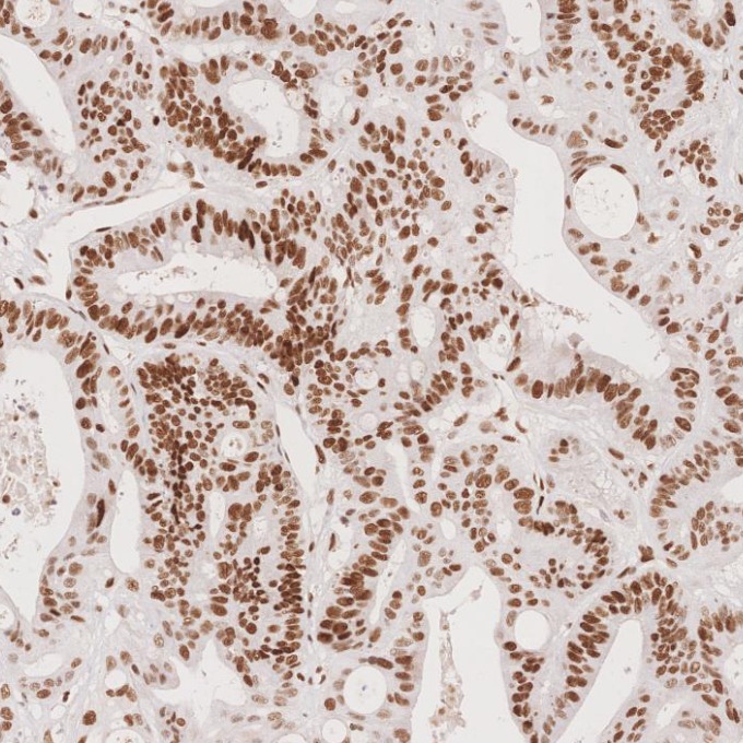 IHC staining of human colorectal cancer using 66172-2-Ig