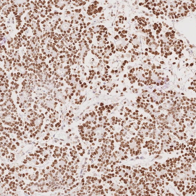 IHC staining of human stomach cancer using 66172-2-Ig
