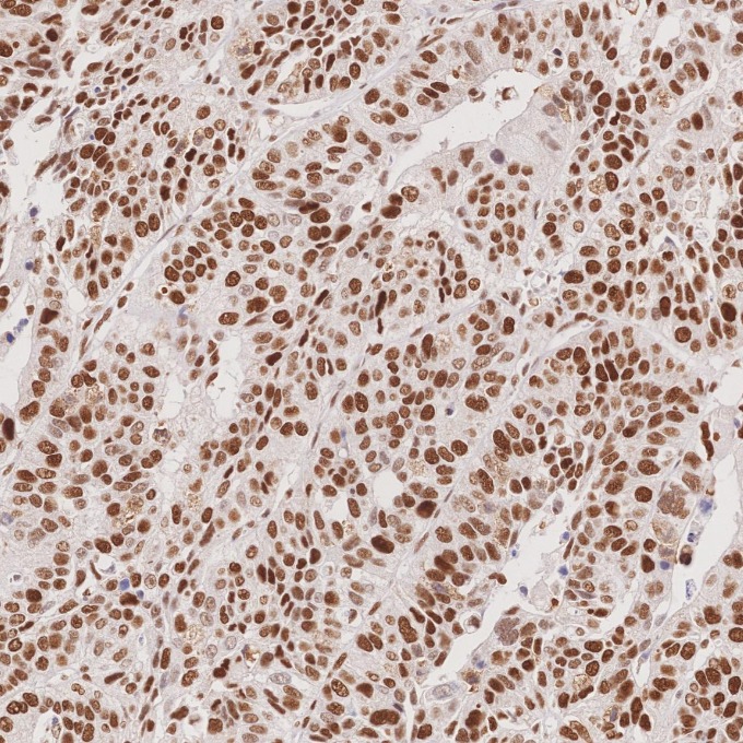 IHC staining of human stomach cancer using 66172-2-Ig