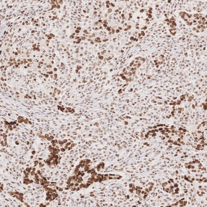 IHC staining of human stomach cancer using 66172-2-Ig