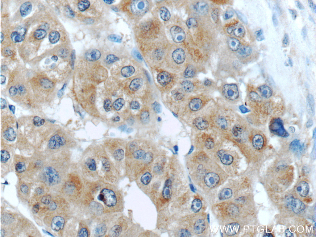IHC staining of human liver cancer using 20579-1-AP