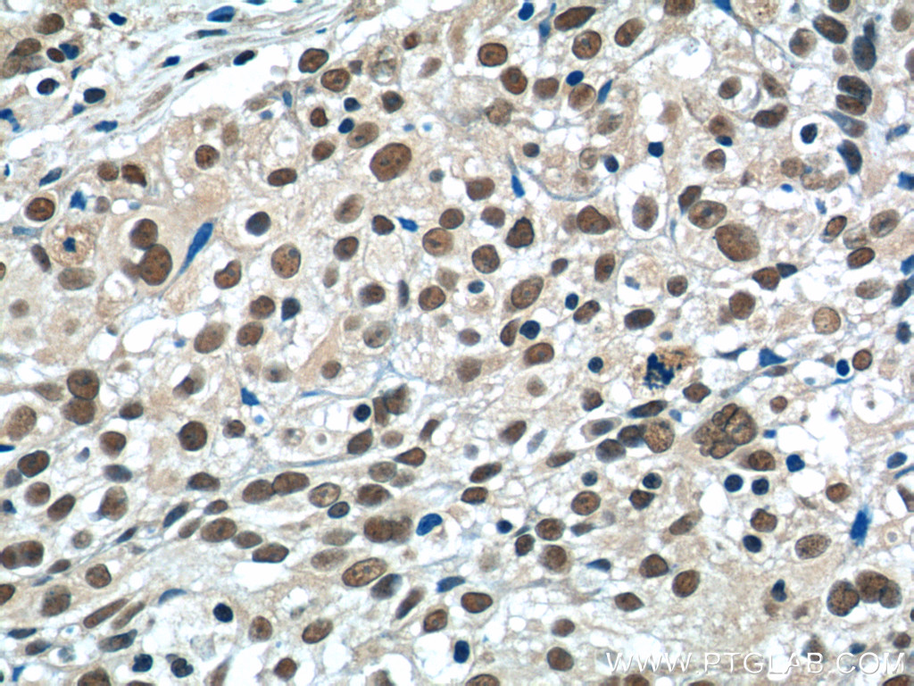 IHC staining of human lung cancer using 20579-1-AP