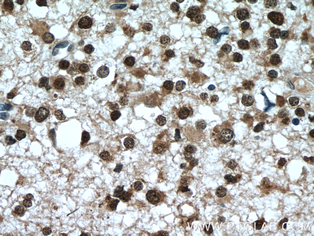 IHC staining of human gliomas using 27185-1-AP