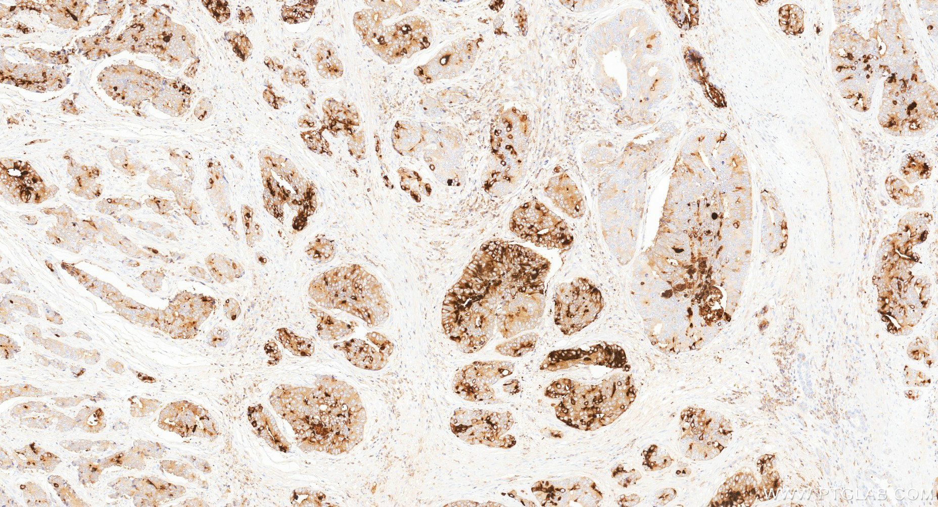IHC staining of human prostate cancer using 87375-1-RR (same clone as 87375-1-PBS) IHC staining of human prostate cancer using 87375-1-RR (same clone as 87375-1-PBS)