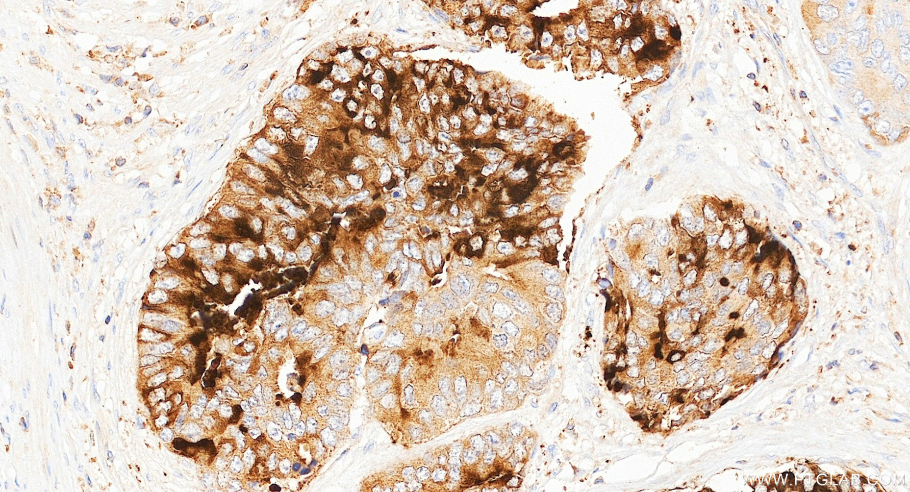IHC staining of human prostate cancer using 87375-1-RR (same clone as 87375-1-PBS) IHC staining of human prostate cancer using 87375-1-RR (same clone as 87375-1-PBS)