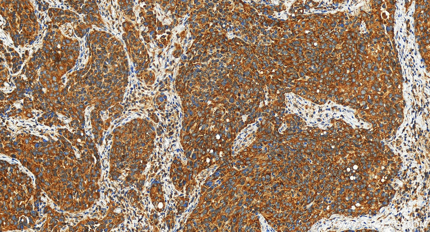 IHC staining of human ovary cancer using 28400-1-AP
