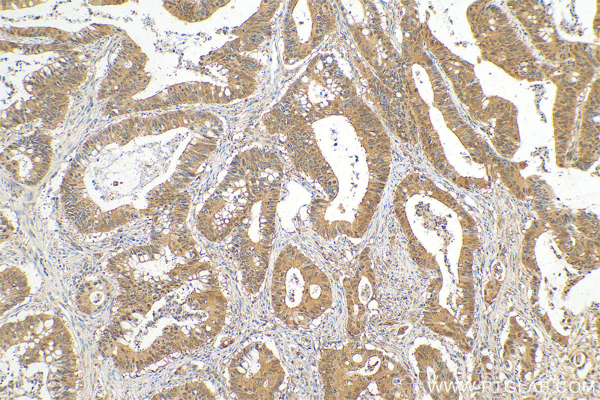 IHC staining of human colon cancer using 11475-1-AP