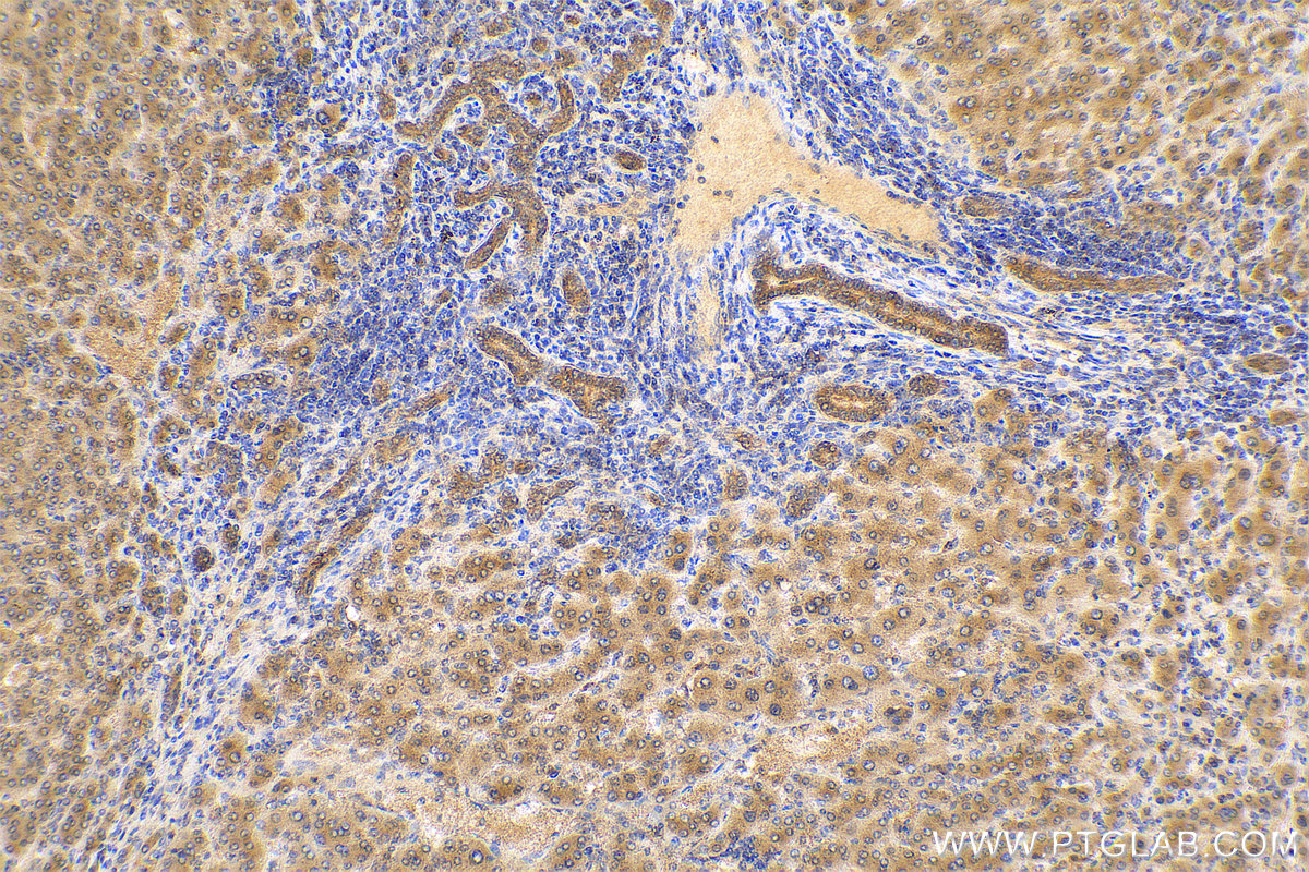 IHC staining of human liver cancer using 11475-1-AP