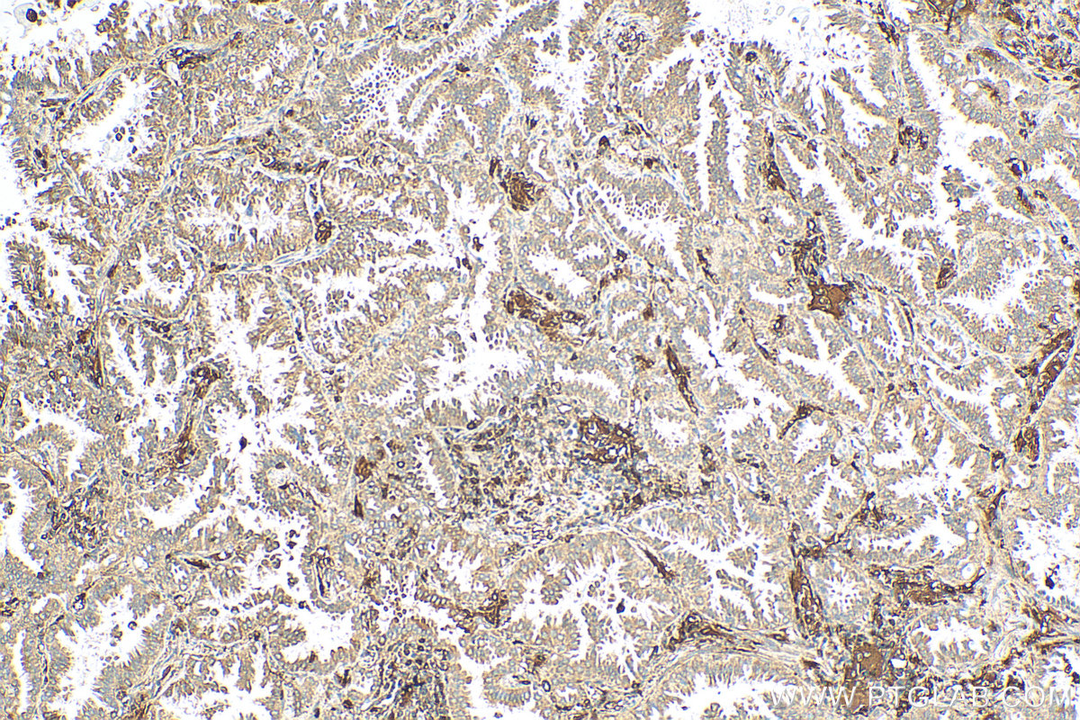 IHC staining of human lung cancer using 28356-1-AP