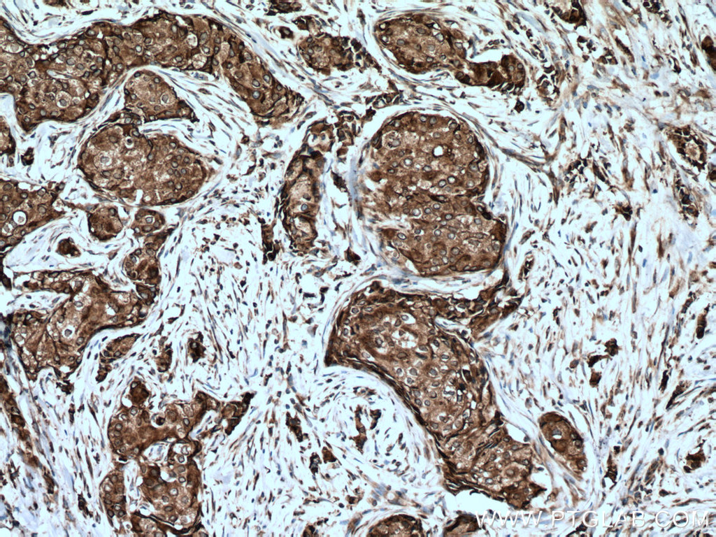 IHC staining of human breast cancer using 13860-1-AP