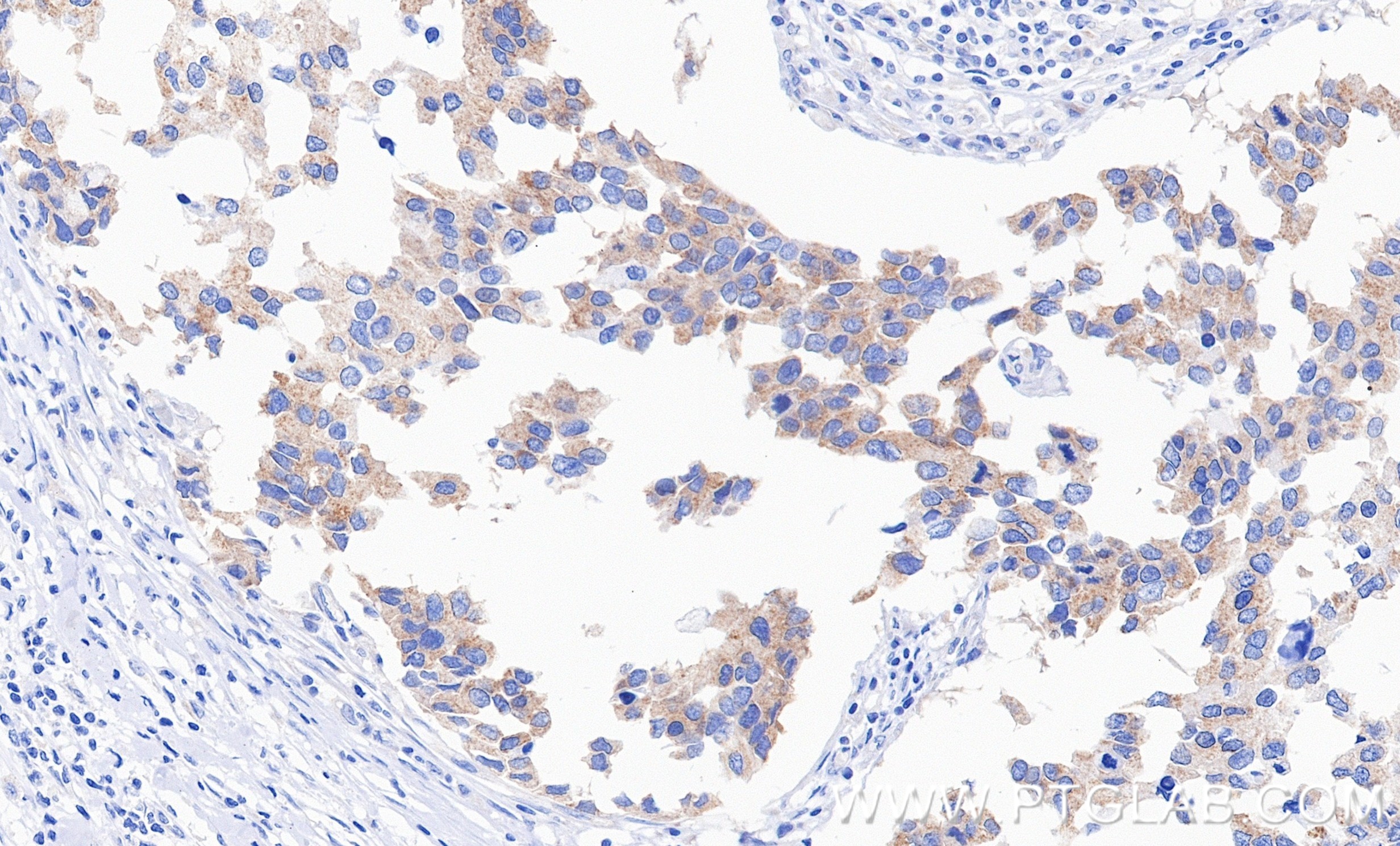 IHC staining of human breast cancer using 87130-1-RR IHC staining of human breast cancer using 87130-1-RR