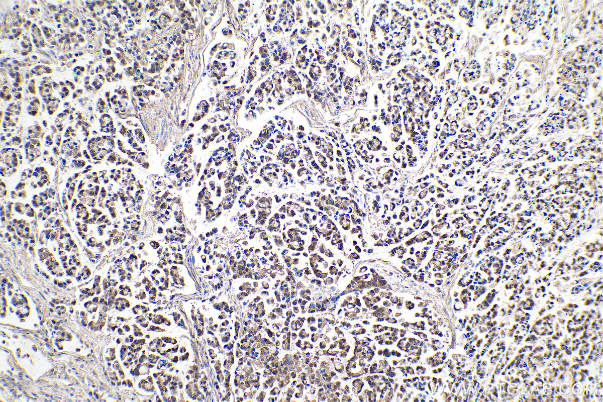 IHC staining of human colon cancer using 67443-1-Ig (same clone as 67443-1-PBS)