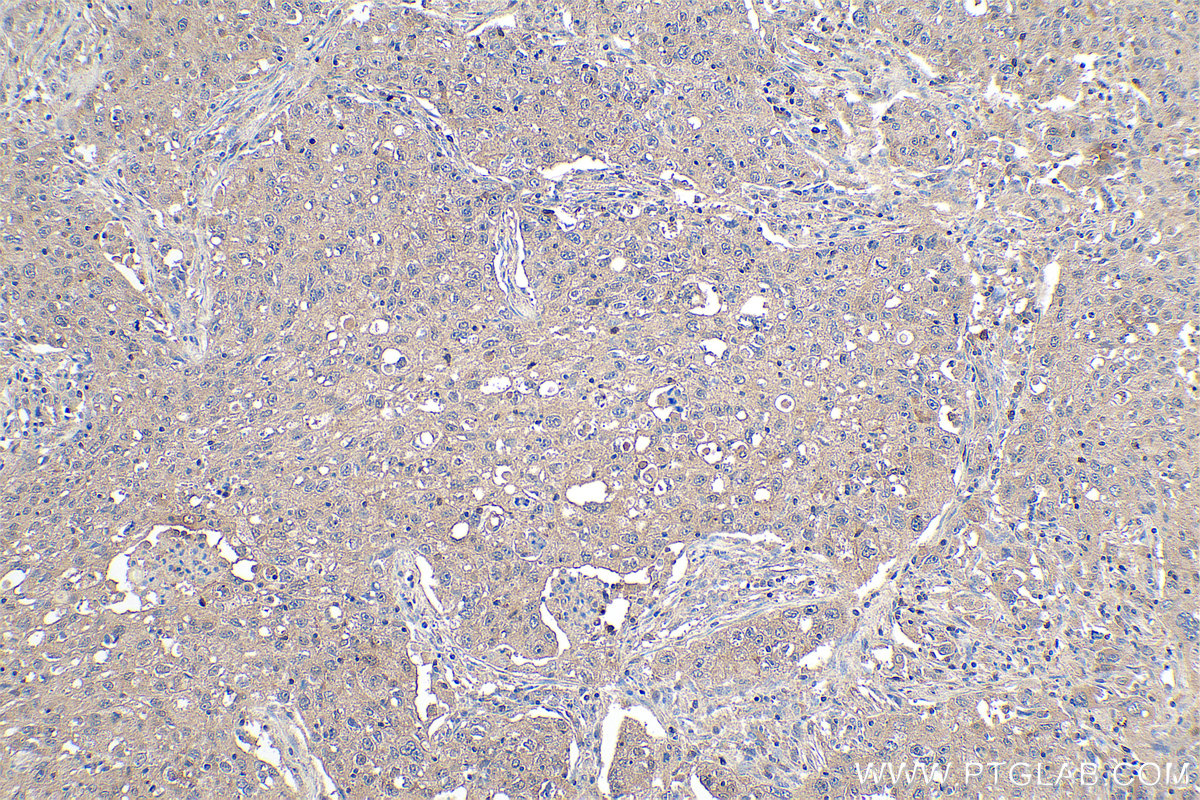 IHC staining of human lung cancer using 67443-1-Ig (same clone as 67443-1-PBS)