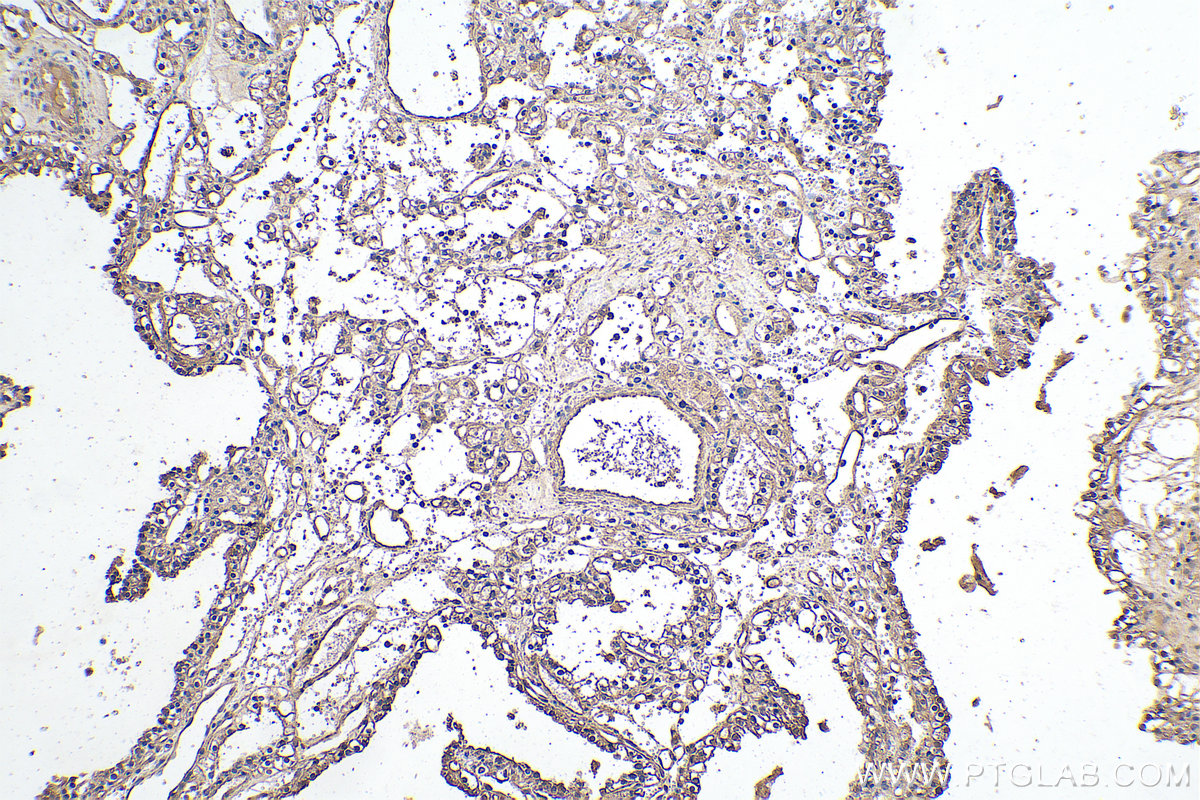 IHC staining of human renal cell carcinoma using 67443-1-Ig