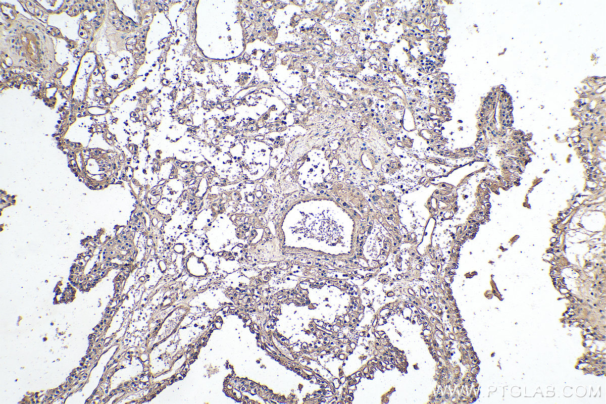 IHC staining of human renal cell carcinoma using 67443-1-Ig (same clone as 67443-1-PBS)
