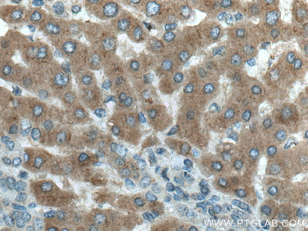 IHC staining of human liver cancer using 10794-1-AP