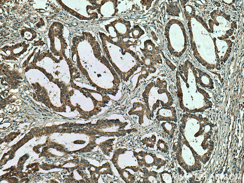 IHC staining of human colon cancer using 67670-1-Ig