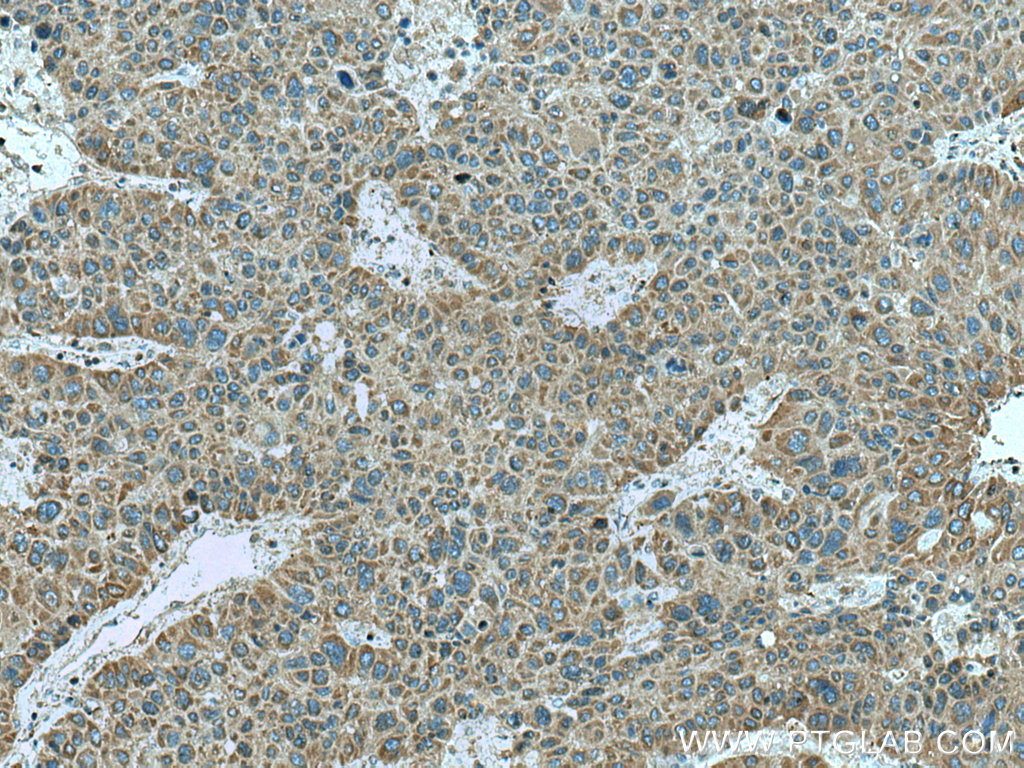 IHC staining of human liver cancer using 16113-1-AP