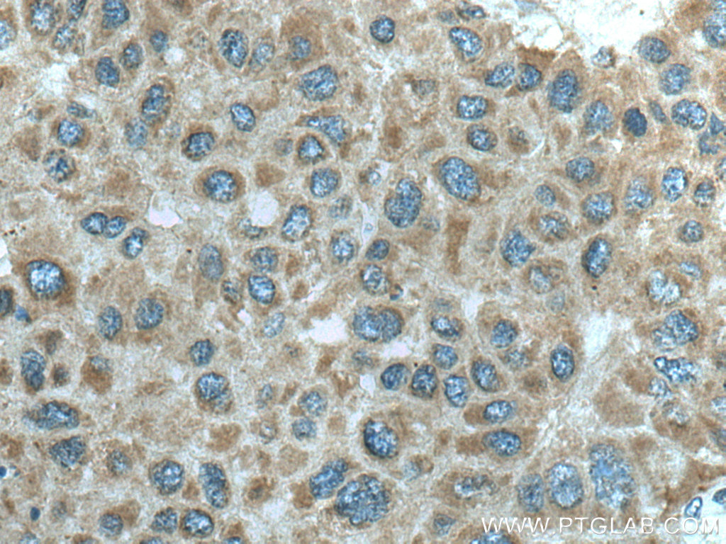 IHC staining of human liver cancer using 16113-1-AP