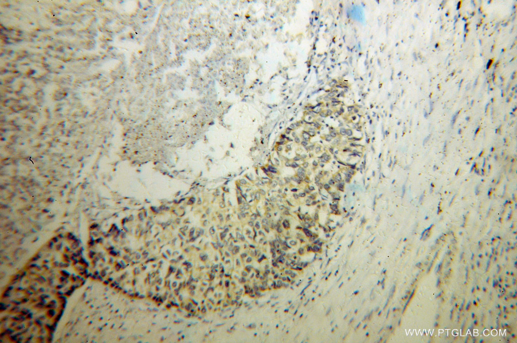 IHC staining of human liver cancer using 13114-1-AP