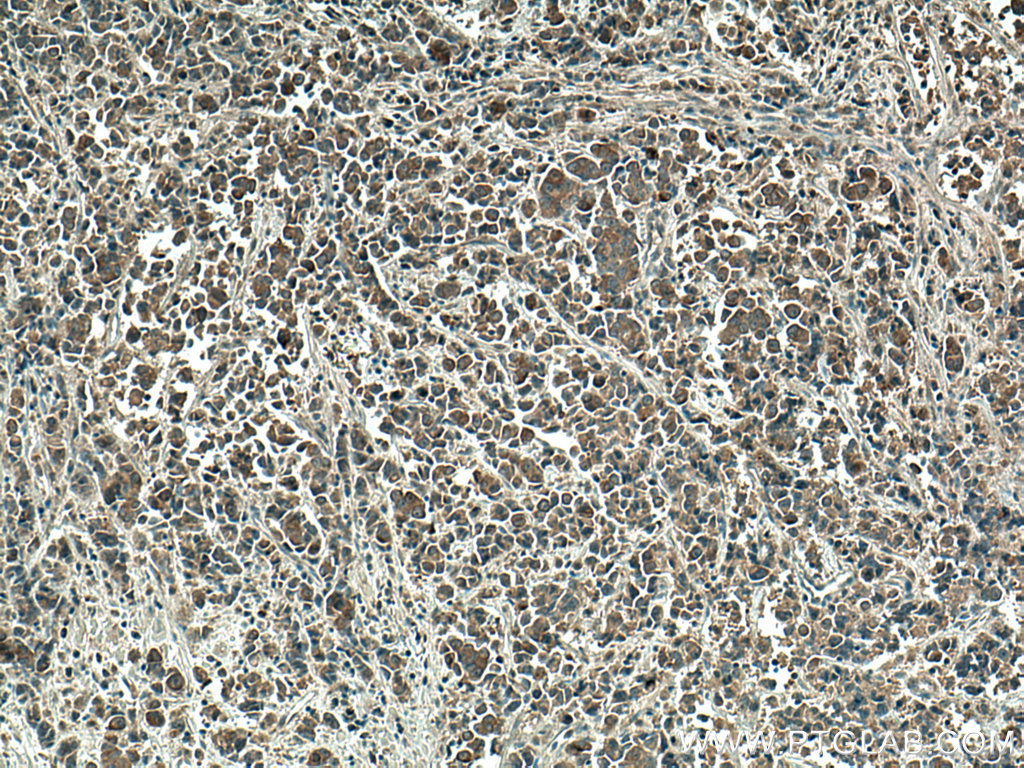 IHC staining of human prostate cancer using 28273-1-AP