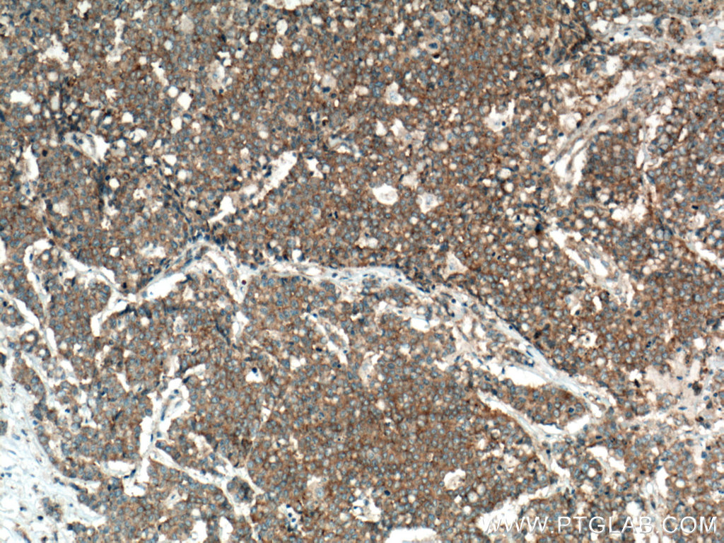 IHC staining of human colon cancer using 66888-1-Ig