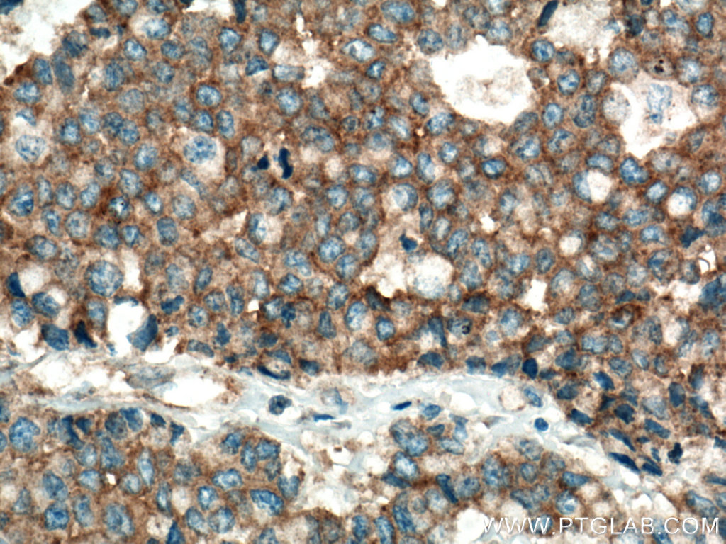 IHC staining of human colon cancer using 66888-1-Ig (same clone as 66888-1-PBS)