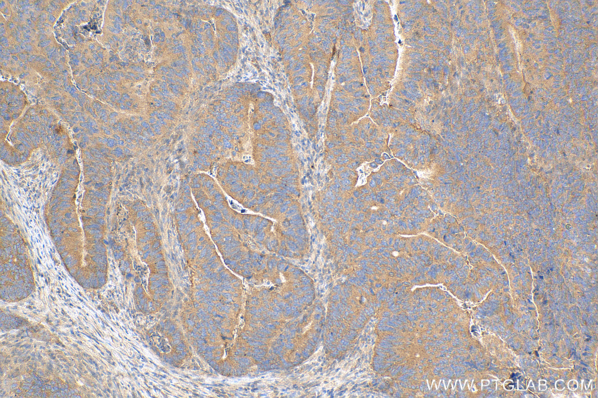 Immunohistochemical analysis of paraffin-embedded human colon cancer tissue slide using <a class='green' href='/productredirect?CatalogNo=81670-1-RR' target='_blank'>81670-1-RR</a> (mTOR antibody) at dilution of 1:200 (under 10x lens). Heat mediated antigen retrieval with Tris-EDTA buffer (pH 9.0). This data was developed using the same antibody clone with 81670-1-PBS in a different storage buffer formulation. IHC staining of human colon cancer using 81670-1-RR (same clone as 81670-1-PBS)
