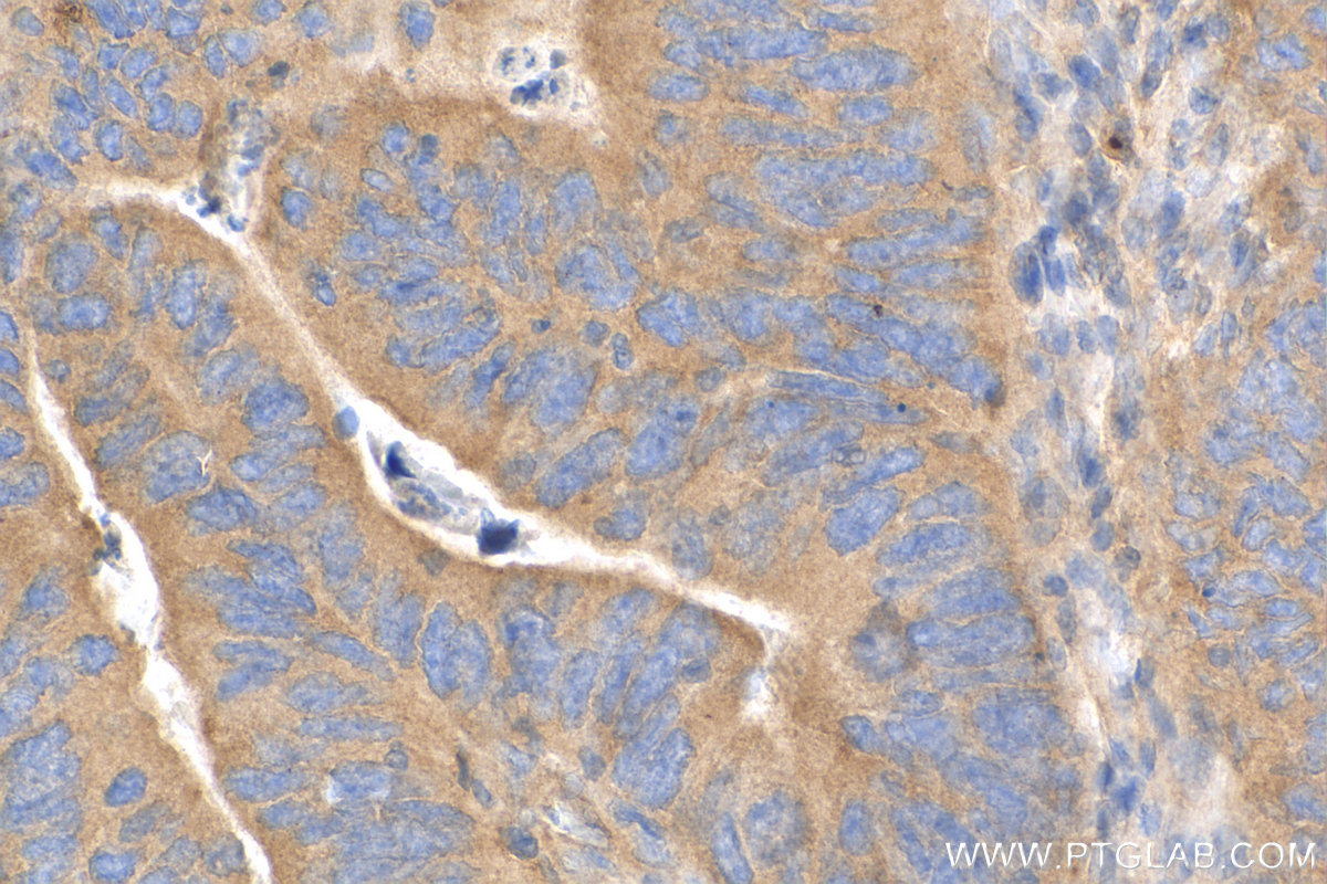 IHC staining of human colon cancer using 81670-1-RR (same clone as 81670-1-PBS)