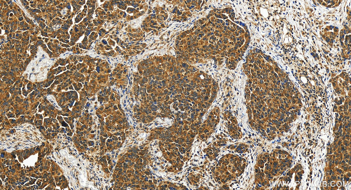 IHC staining of human ovary cancer using 26944-1-AP