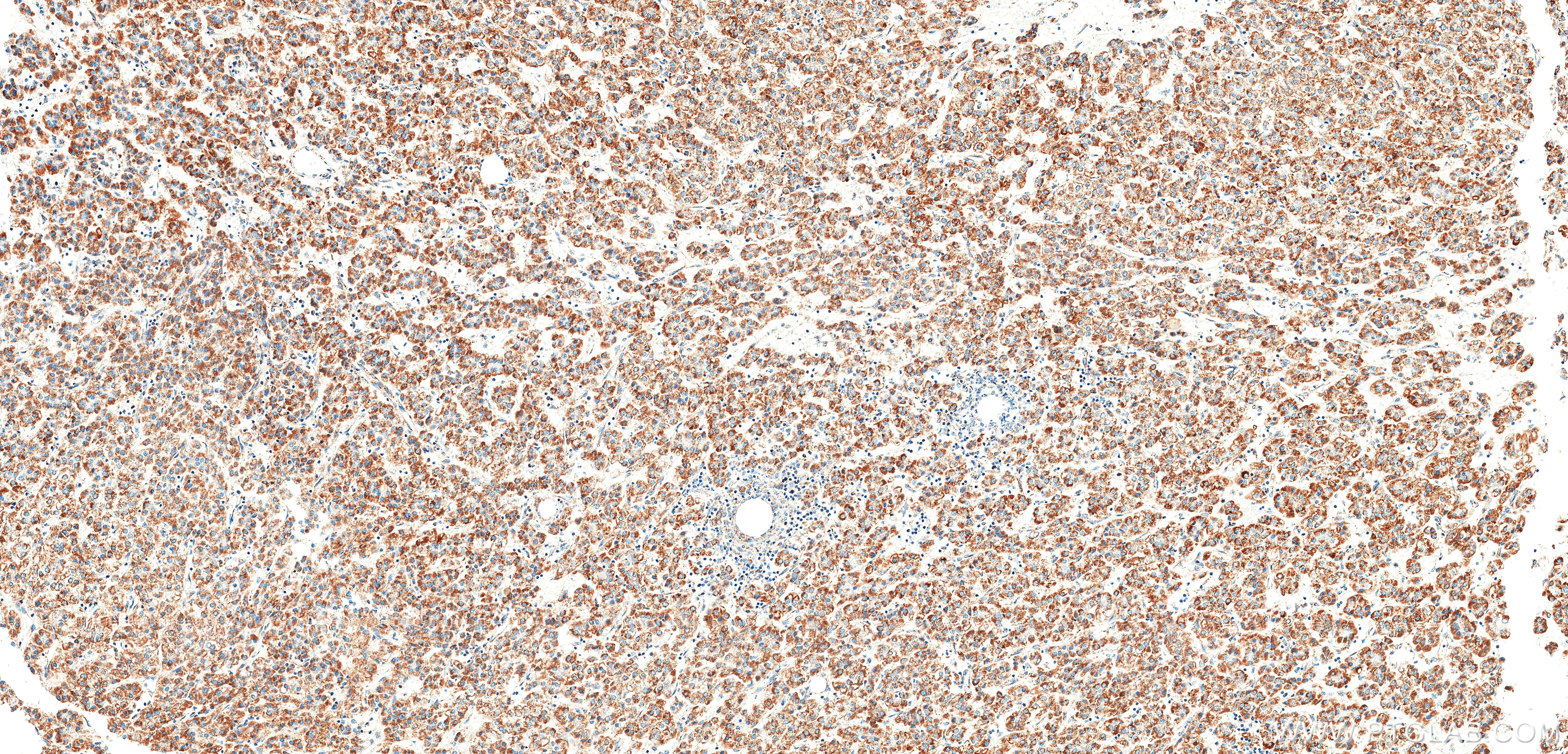 IHC staining of Human Hepatocellular cancer using 86899-1-RR (same clone as 86899-1-PBS) IHC staining of Human Hepatocellular cancer using 86899-1-RR (same clone as 86899-1-PBS)