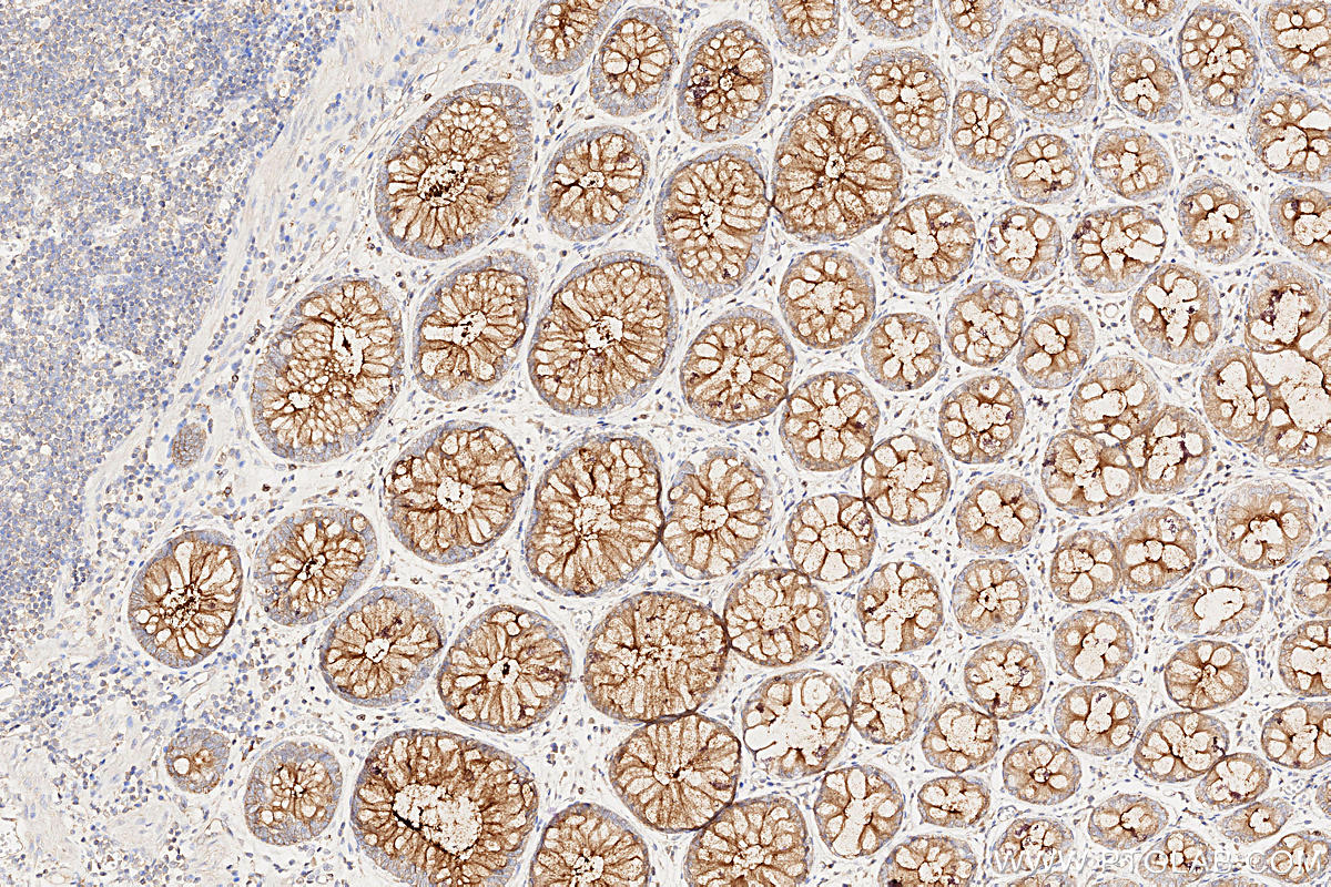 IHC staining of human rectal cancer using 60749-1-Ig