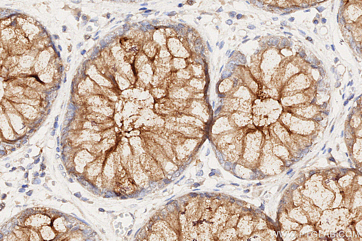 IHC staining of human rectal cancer using 60749-1-Ig