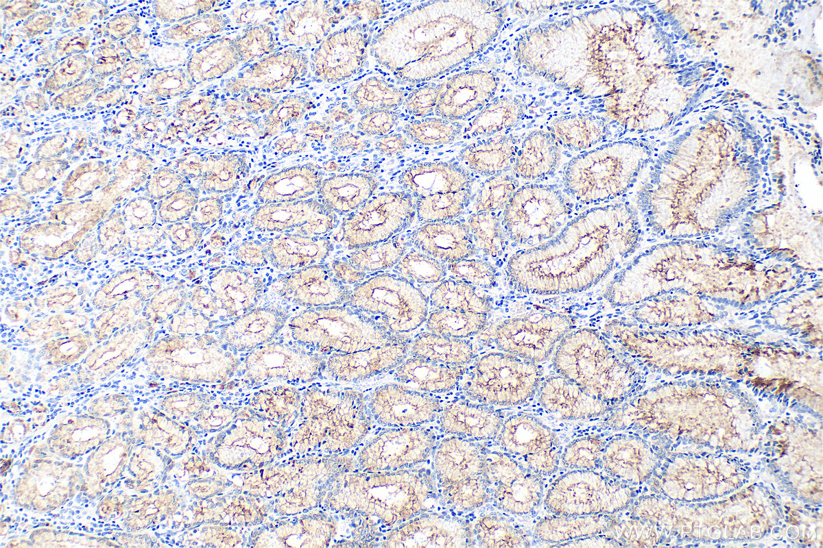 IHC staining of human stomach cancer using 60749-1-Ig