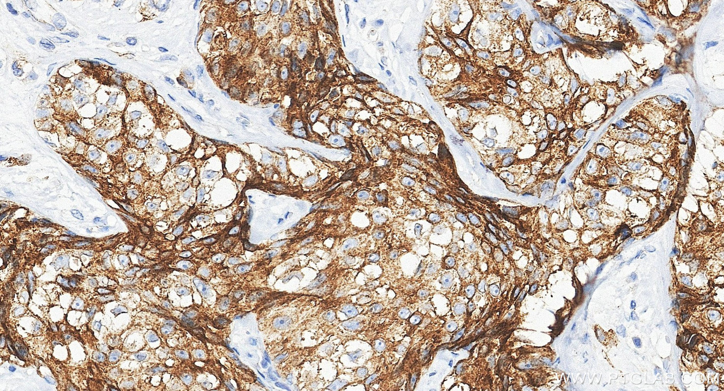 IHC staining of human breast cancer using 60749-1-Ig IHC staining of human breast cancer using 60749-1-Ig