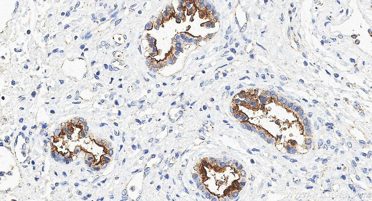 IHC staining of human liver cancer using 60749-1-Ig IHC staining of human liver cancer using 60749-1-Ig
