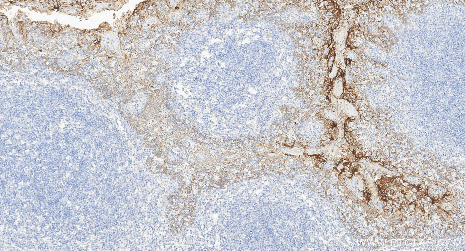 IHC staining of human tonsillitis using 60749-1-Ig IHC staining of human tonsillitis using 60749-1-Ig