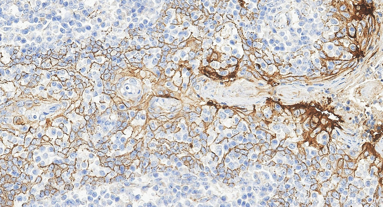IHC staining of human tonsillitis using 60749-1-Ig IHC staining of human tonsillitis using 60749-1-Ig