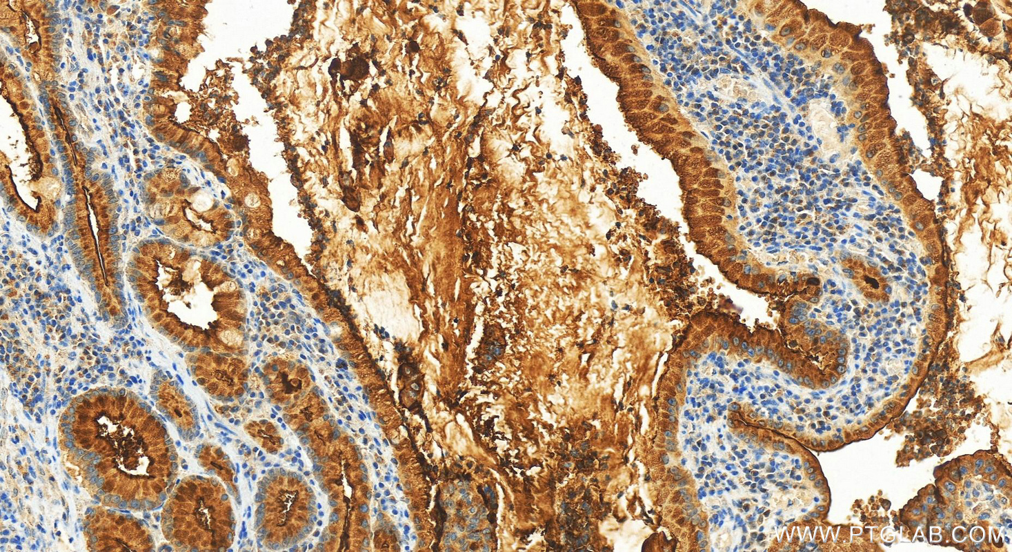 IHC staining of human stomach cancer using 83311-4-RR