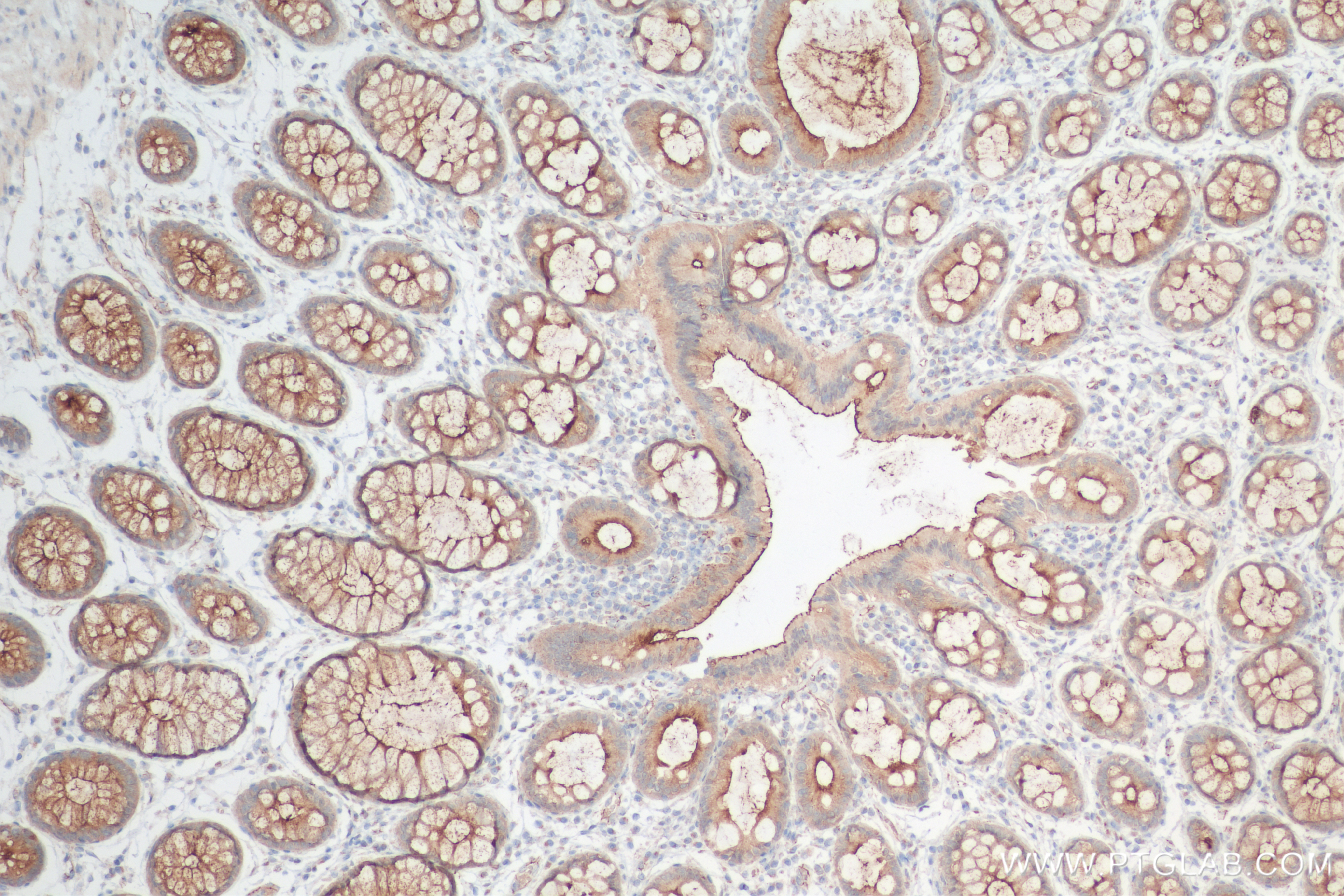 IHC staining of human rectal cancer using 83311-4-RR