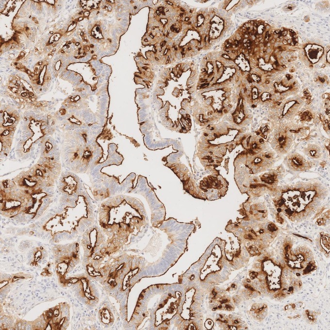 IHC staining of human pancreas cancer using 83311-4-RR IHC staining of human pancreas cancer using 83311-4-RR