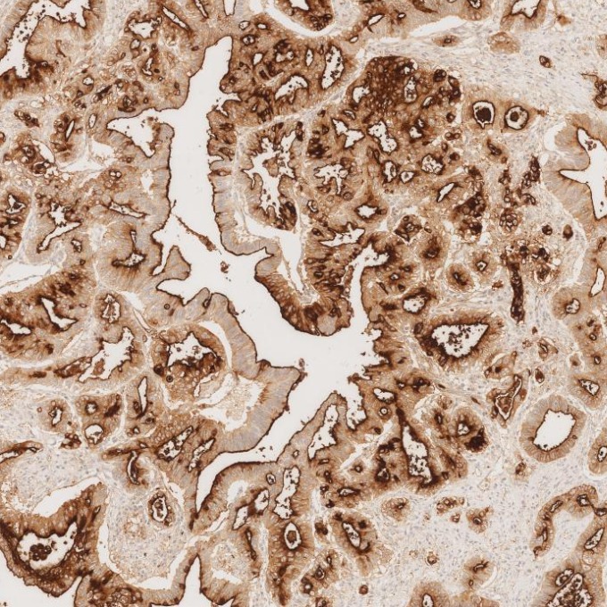 IHC staining of human pancreas cancer using 83311-4-RR IHC staining of human pancreas cancer using 83311-4-RR