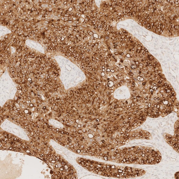 IHC staining of human ovary cancer using 83311-4-RR IHC staining of human ovary cancer using 83311-4-RR