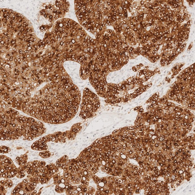 IHC staining of human ovary cancer using 83311-4-RR IHC staining of human ovary cancer using 83311-4-RR