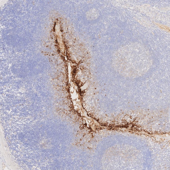 IHC staining of human tonsillitis using 83311-4-RR IHC staining of human tonsillitis using 83311-4-RR