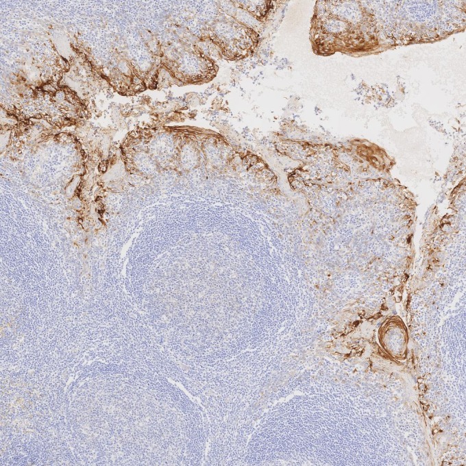 IHC staining of human tonsillitis using 83311-4-RR IHC staining of human tonsillitis using 83311-4-RR