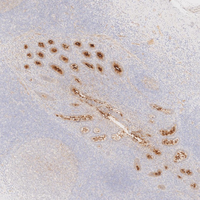 IHC staining of human appendicitis using 83311-4-RR IHC staining of human appendicitis using 83311-4-RR