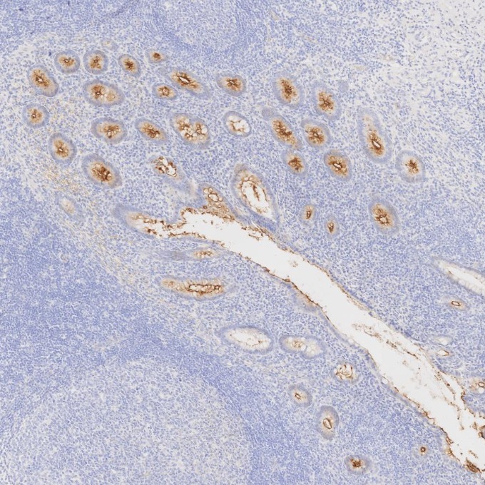 IHC staining of human appendicitis using 83311-4-RR IHC staining of human appendicitis using 83311-4-RR