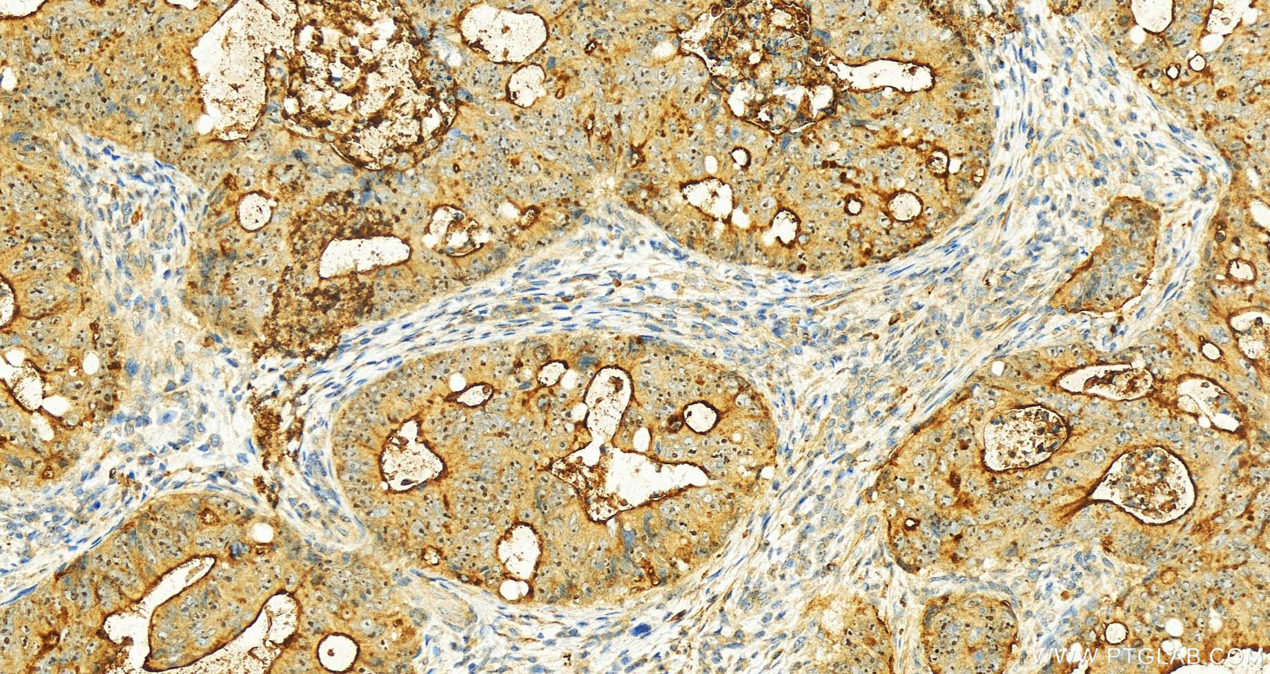 IHC staining of human colon cancer using 55487-1-AP